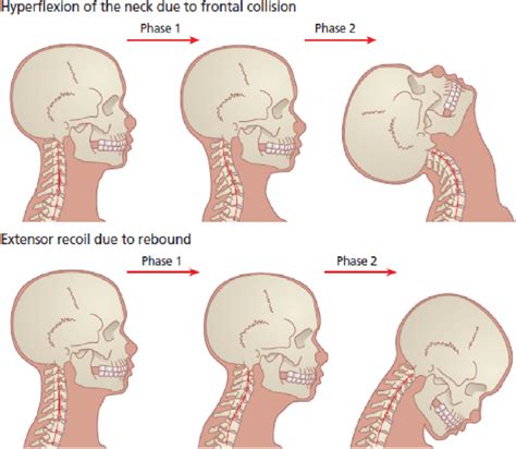 Although elderly patients frequently have hyperactive carotid sinus reflexes. . Hyperextension of neck in dying